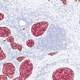 Illustration for article titled Breast Cancer May Actually Be 10 Completely Different Diseases